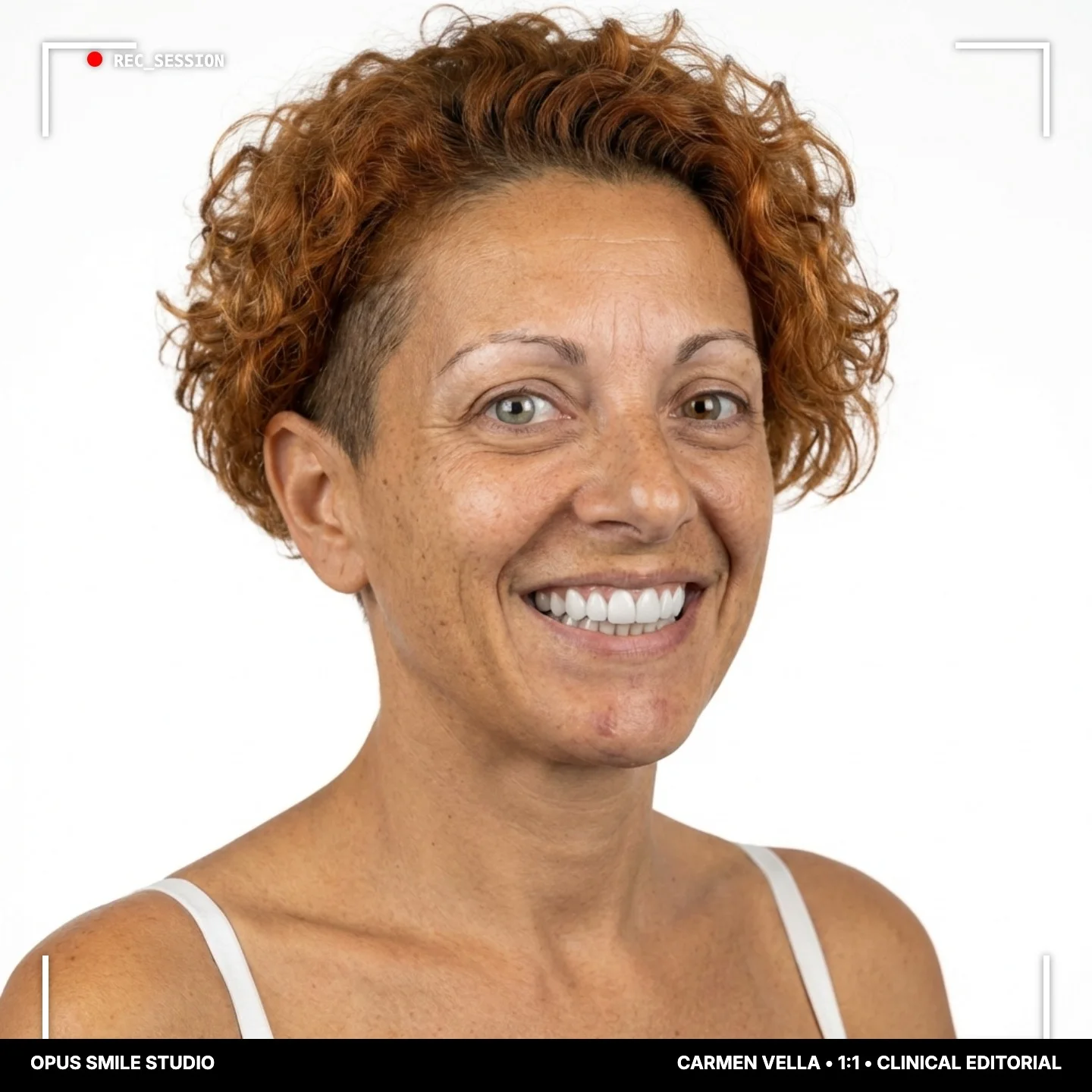 Carmen Vella after Porcelain veneers